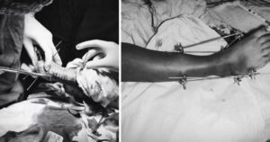 Raigarh News: क्लब फुट का समय पर इलाज बना बच्चों के लिए वरदान, पोंसेटी तकनीक से मिल रही नई जिंदगी, 260 से अधिक बच्चों को क्लब फुट से मिली मुक्ति