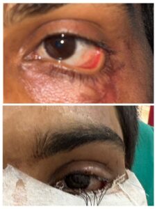 स्किन ग्राफ्टिंग से मरीज के पलक का सफल पुनर्निर्माण, युवक को नई दृष्टि और सामान्य जीवन की ओर लौटने का मिला अवसर