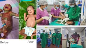Chhattisgarh News: सुदूर बीजापुर में चिकित्सा चमत्कार : अत्यंत दुर्लभ बीमारी से जूझते शिशु को बचाया, केले के पत्तों से किया गया विशेष देखभाल