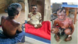 घर के अंदर खौलता कहर: शराब बनाने से रोका तो पत्नी ने उंडेला उबलता पानी, जिंदगी से जंग लड़ रहा पति