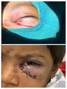 बिल्हा क्षेत्र के बटोरी गांव में आवारा कुत्ते के हमले में घायल दो मासूम बच्चों का सिम्स में सफल उपचार, नेत्र रोग विभाग की टीम ने किया जटिल पलक सर्जरी, समय पर इलाज से बची आंखों की रोशनी