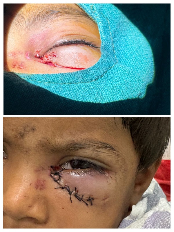 बिल्हा क्षेत्र के बटोरी गांव में आवारा कुत्ते के हमले में घायल दो मासूम बच्चों का सिम्स में सफल उपचार, नेत्र रोग विभाग की टीम ने किया जटिल पलक सर्जरी, समय पर इलाज से बची आंखों की रोशनी