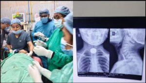 सिम्स बिलासपुर में डॉक्टरों का कमाल, 6 वर्षीय मासूम की आहार नली से सफलतापूर्वक निकाला गया सिक्का, बची जान