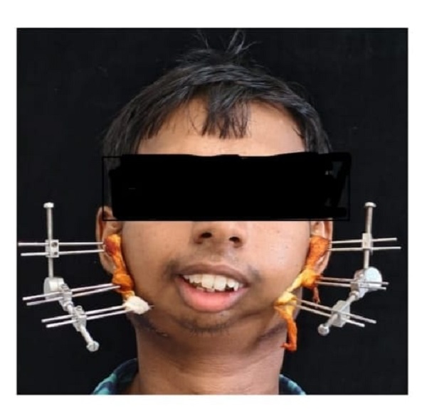 CG News: सिम्स में 24 वर्षीय युवक के बचपन से बंद जबड़े का सफल ऑपरेशन, जटिल सर्जरी से खुला मुंह, आयुष्मान योजना से मिला निःशुल्क उपचार
